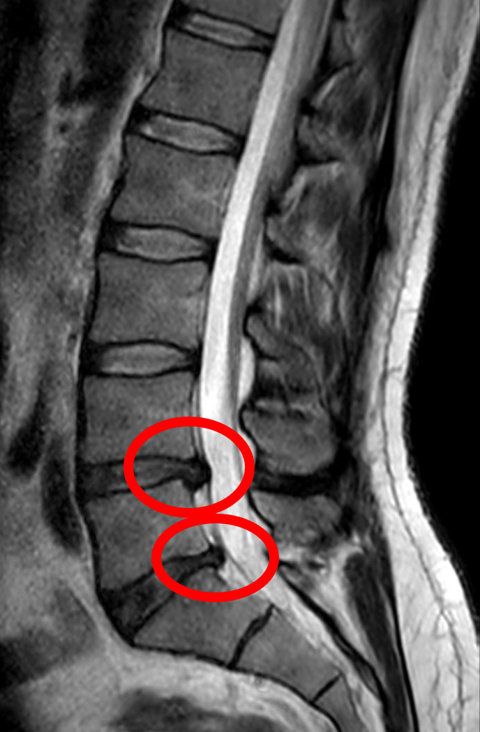 Lomber disk ve sinir yapısı şeması