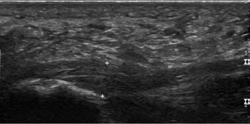 Plantar fasya lateral anatomi şeması